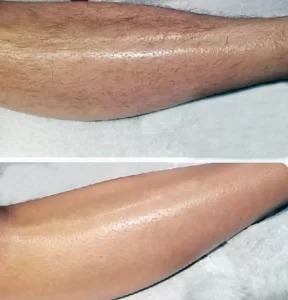 laser hair removal before and after 06