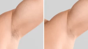 laser hair removal before and after 04