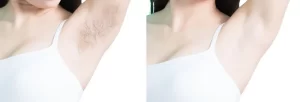laser hair removal before and after 01